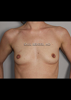 Nipple Inversion/Projection Correction – Case 1