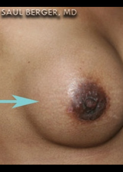 Nipple Inversion/Projection Correction – Case 2