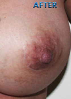 Nipple Inversion/Projection Correction – Case 3