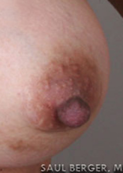 Nipple Inversion/Projection Correction – Case 3