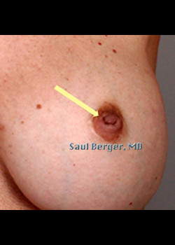Nipple Inversion/Projection Correction – Case 4