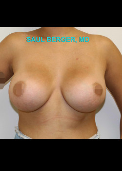 Breast Augmentation With Silicone Gel Implants – Case 20
