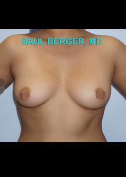 Breast Augmentation With Silicone Gel Implants – Case 20