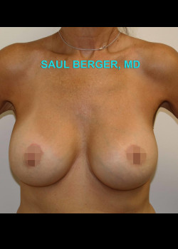 Breast Revision With Implant Replacement And Crescent Lift – Case 8