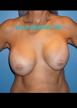 Breast Revision With Implant Replacement And Crescent Lift – Case 8