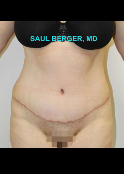 Tummy Tuck (Abdominoplasty) With Liposuction Of Upper Abdomen – Case 11