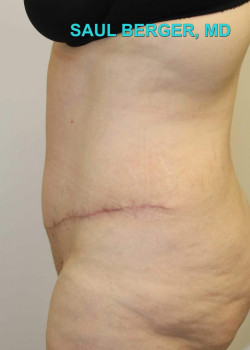 Tummy Tuck (Abdominoplasty) With Liposuction Of Upper Abdomen – Case 11
