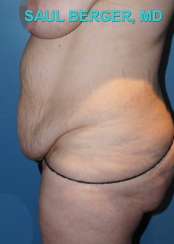 Tummy Tuck (Abdominoplasty) With Liposuction Of Upper Abdomen – Case 11