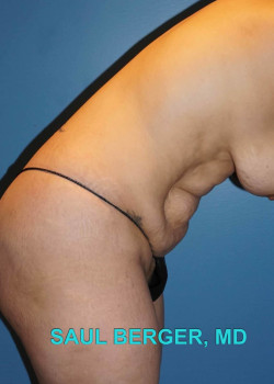 Tummy Tuck (Abdominoplasty) – Case 12