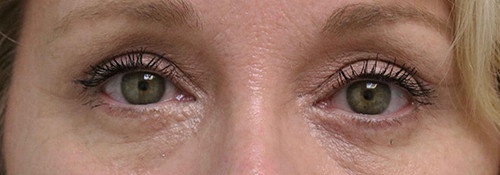 Upper Blepharoplasty, Lower Blepharoplasty and Endoscopic Brow Lift