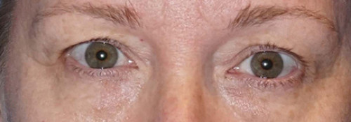 Upper Blepharoplasty, Lower Blepharoplasty and Endoscopic Brow Lift