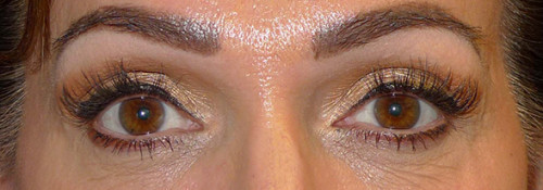 Upper Blepharoplasty, Lower Blepharoplasty and Endoscopic Brow Lift