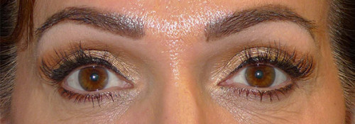 Upper Blepharoplasty, Lower Blepharoplasty and Endoscopic Brow Lift