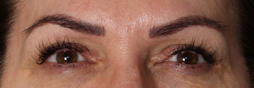 Upper Blepharoplasty, Lower Blepharoplasty and Endoscopic Brow Lift