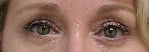 Upper Blepharoplasty, Lower Blepharoplasty and Endoscopic Brow Lift