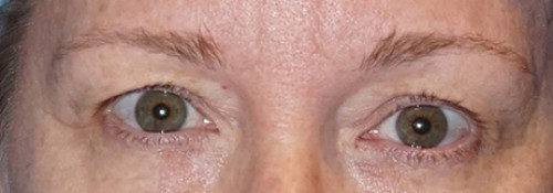 Upper Blepharoplasty, Lower Blepharoplasty and Endoscopic Brow Lift